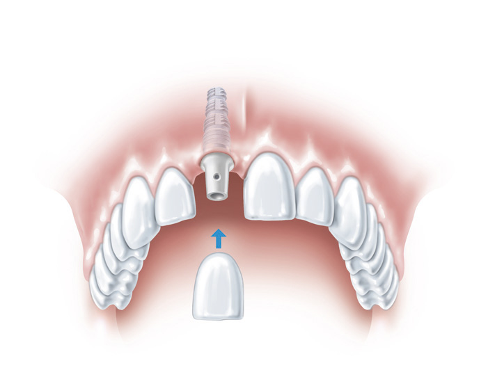dental implant mouth example with titanium post