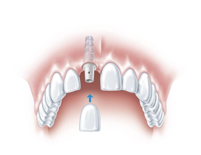 Dental implant