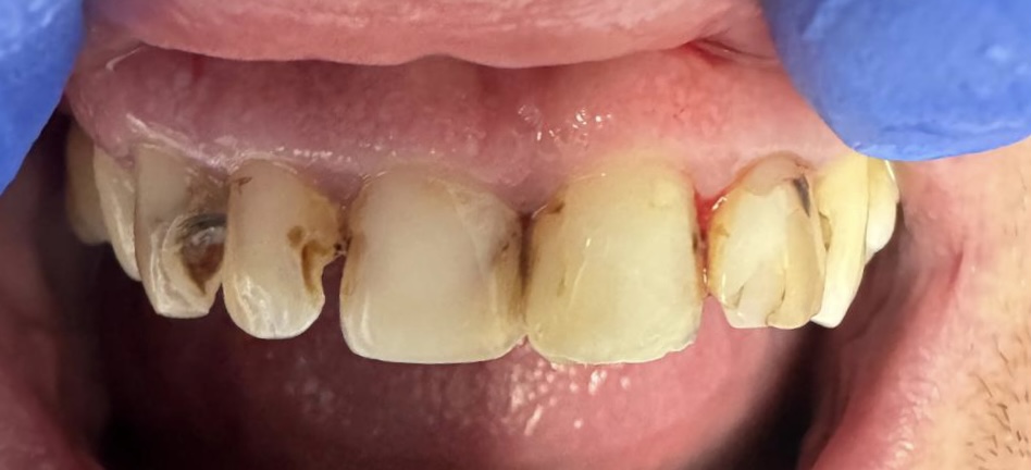 Cracked teeth before composite bonding