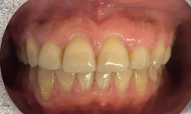 Teeth shape after composite bonding