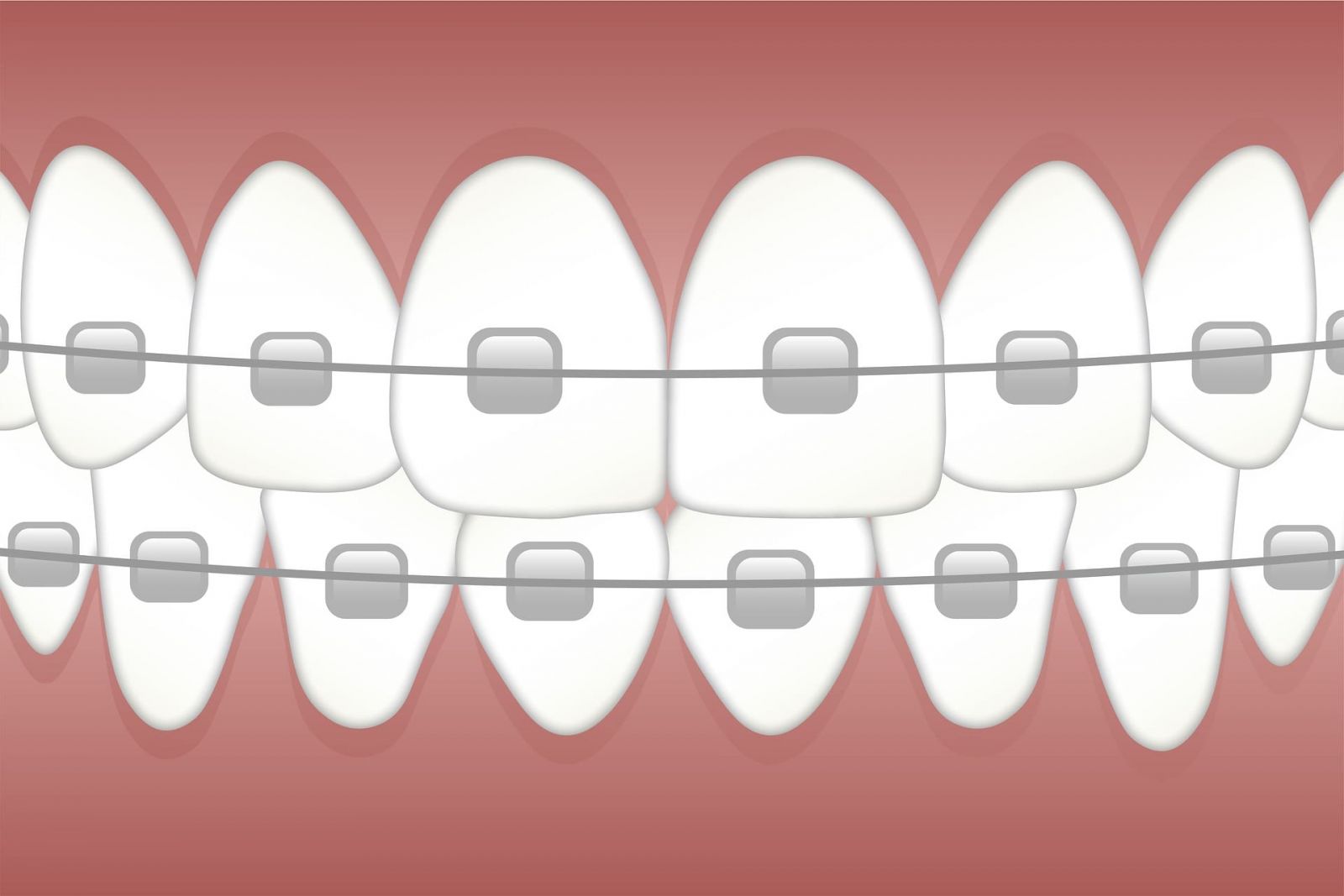 Teeth Straightening Glasgow