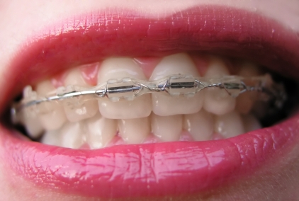 Braces for Adults, Braces in West Midlands
