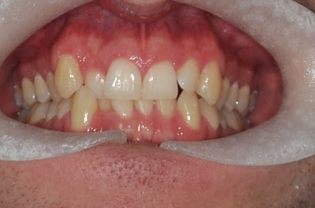 before clear aligner treatment