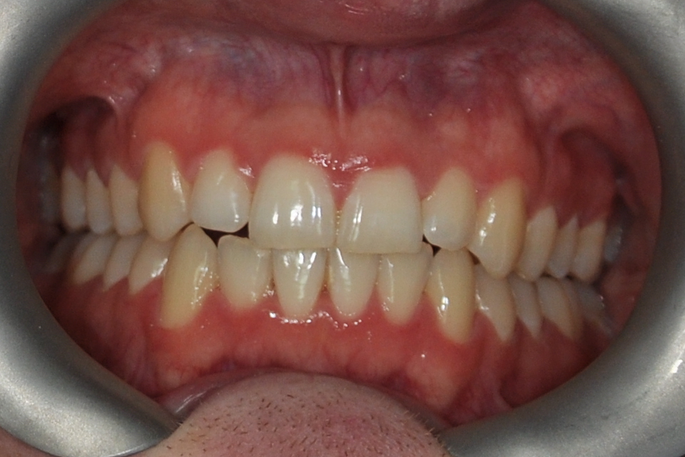 after clear aligner treatment 