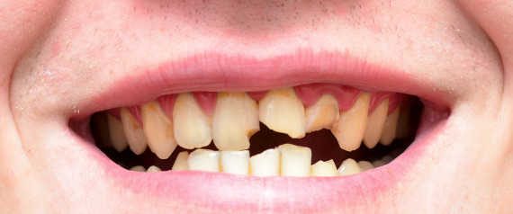 damaged smile from a sports injury