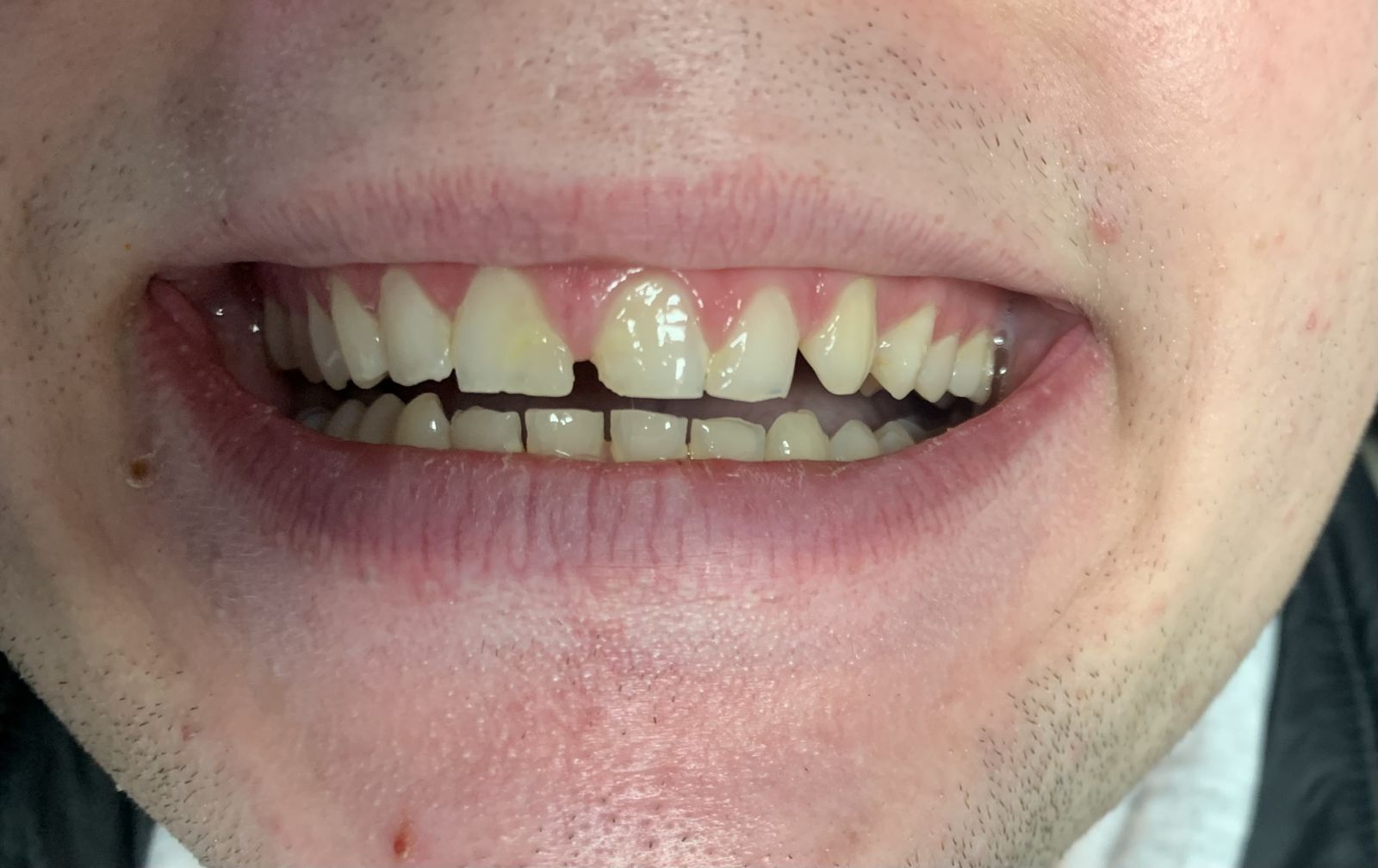Teeth gap before composite bonding