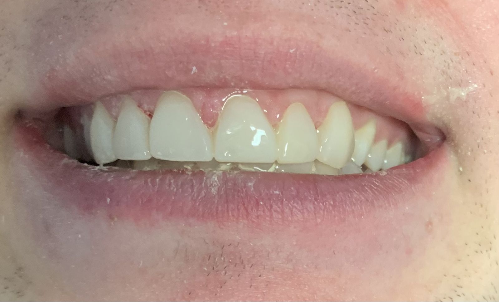 Teeth gap after composite bonding