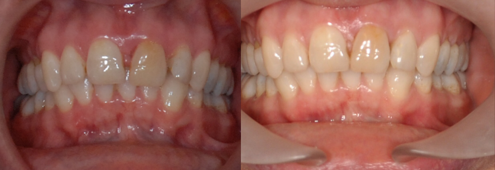 before and after clear aligner treatment 