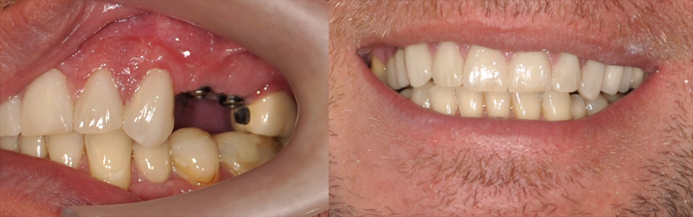 dental implant surgery before and after