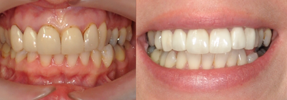 Sample veneers from Park Practice