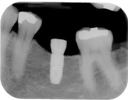 dental implant x-ray