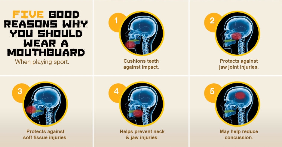 graphic explaining the importance of wearing a mouth guard