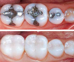 white resin fillings against metal amalgam fillings