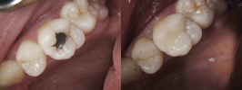 comparison between white fillings and amalgam fillings
