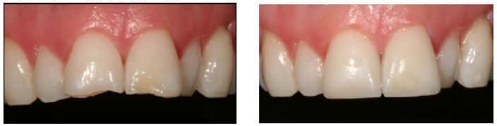 composite restoration work done to front teeth. Before and after