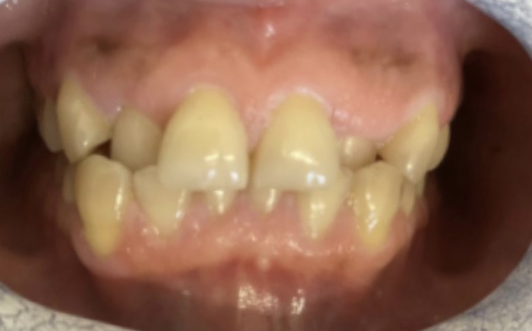 Teeth shape before composite bonding