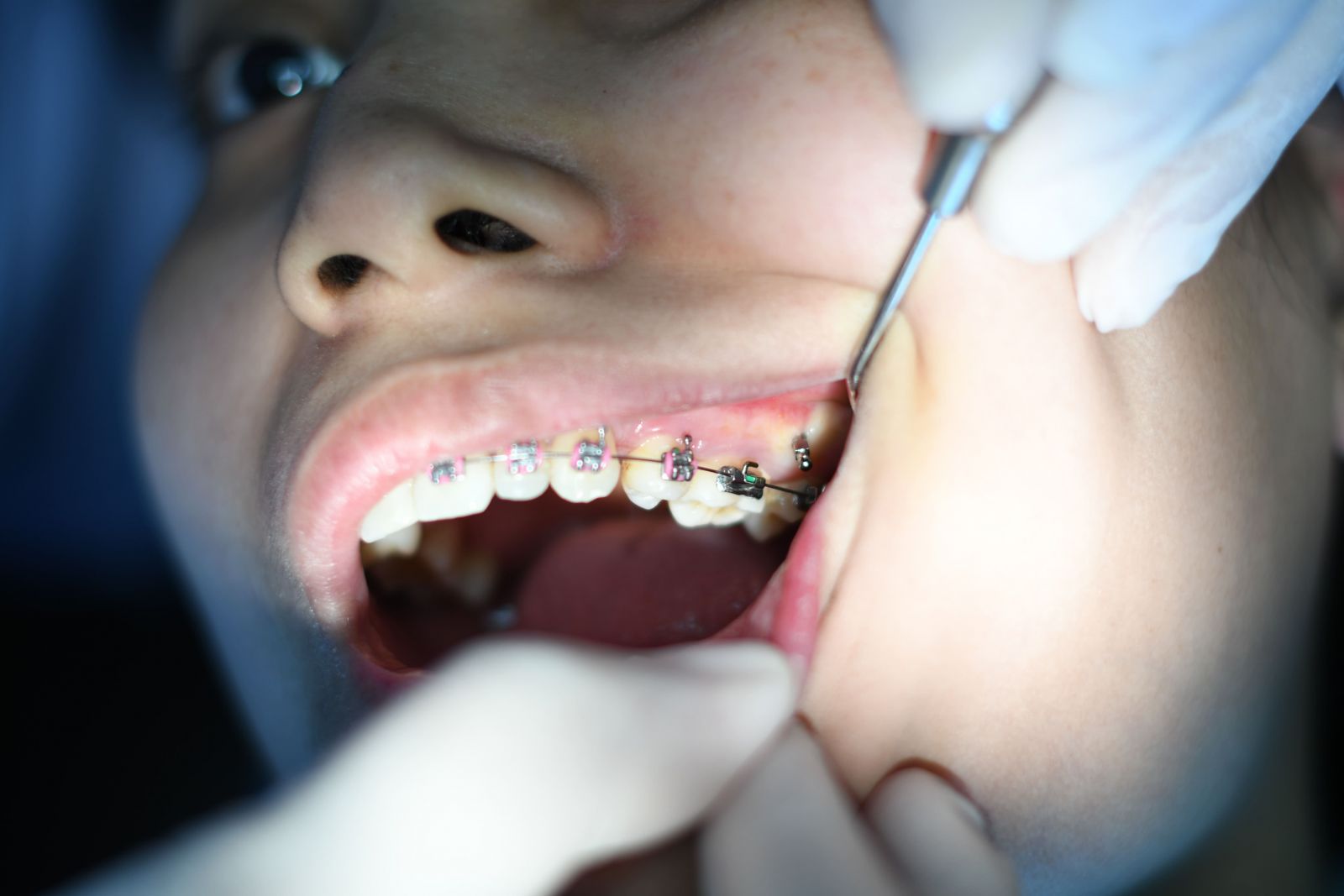 dental braces maintenance 