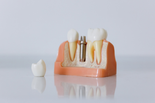 dental implant model example