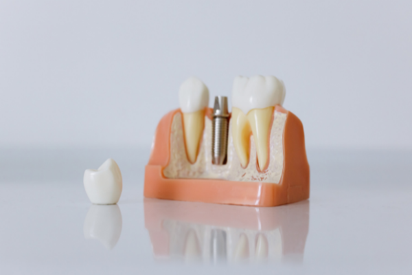 model of professional dental implant in Glasgow