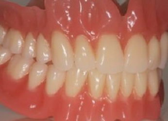Dentures Glasgow, and example set of dentures