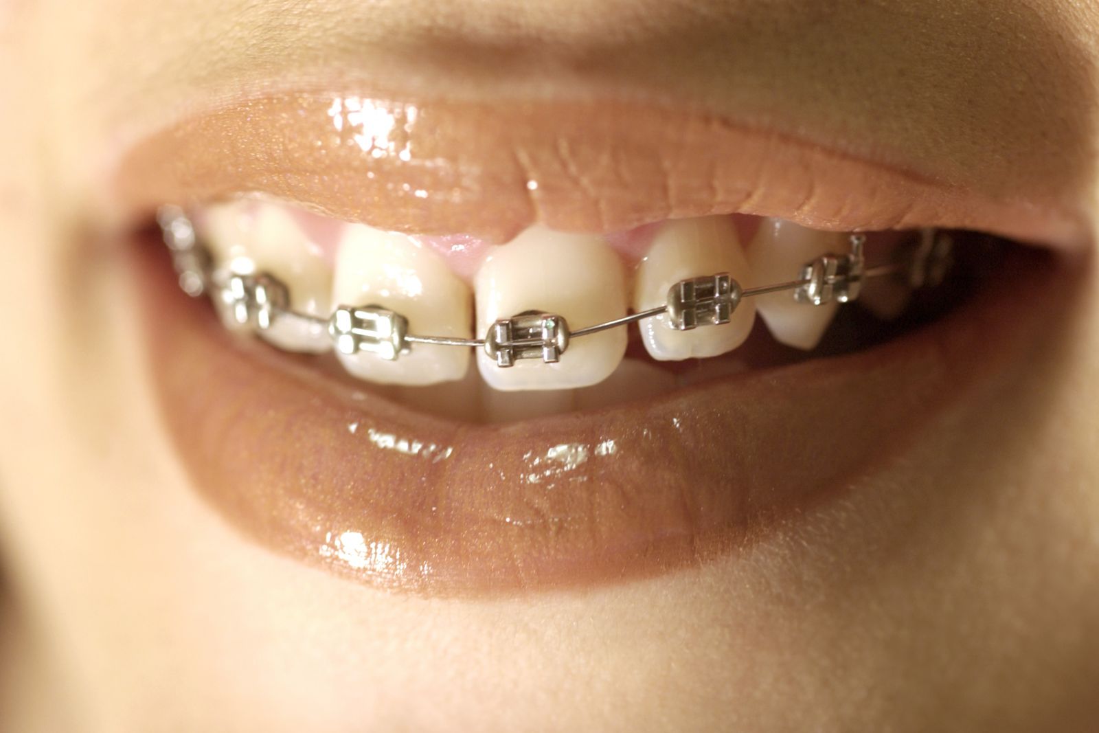 lingual braces for adults 