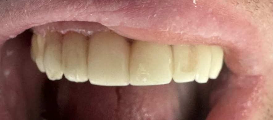 Cracked teeth after composite bonding
