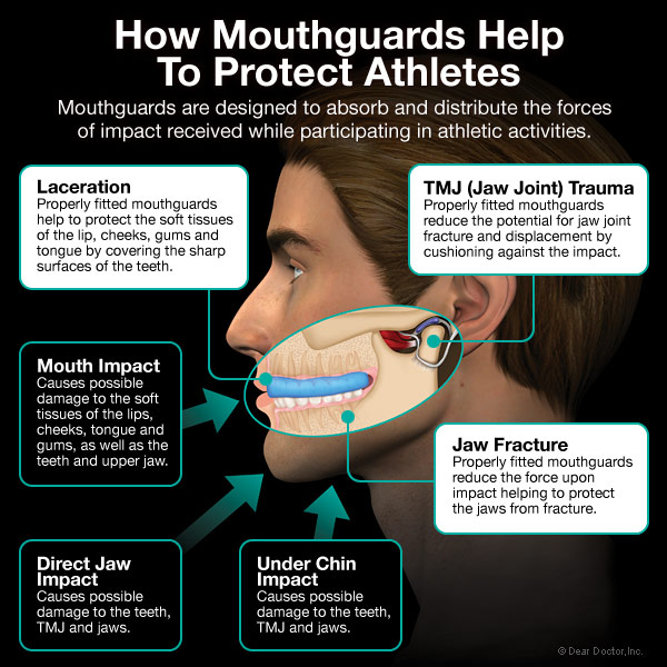 sports mouth guards reasons to wear one
