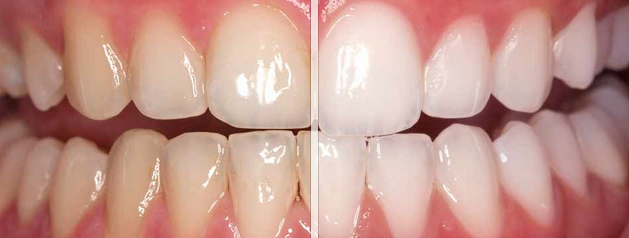 Teeth whitening result