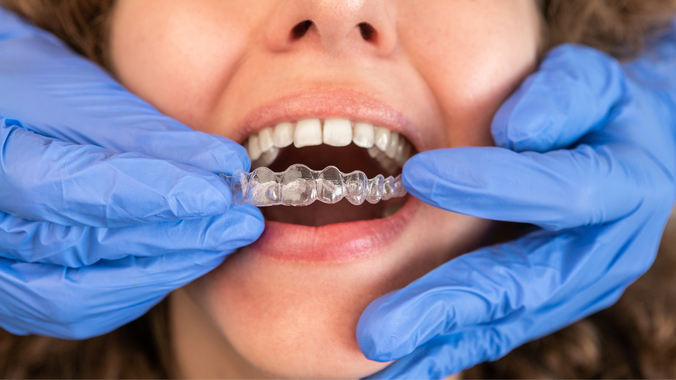 Custom tray whitening