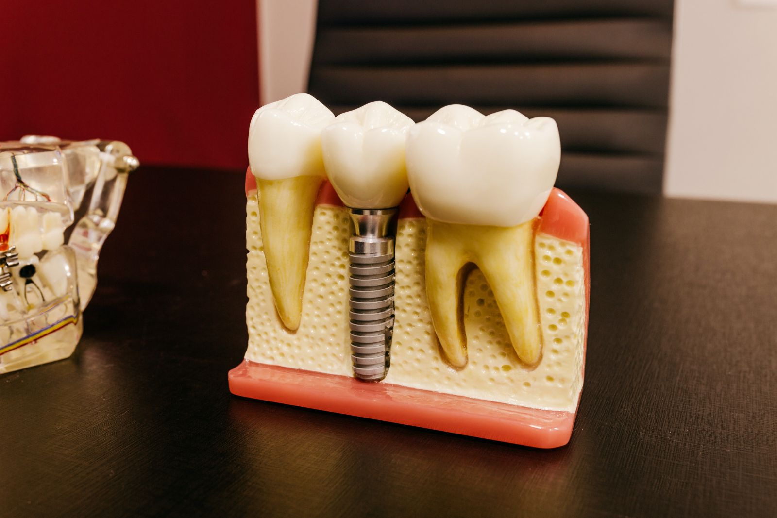 Dental implants explained 